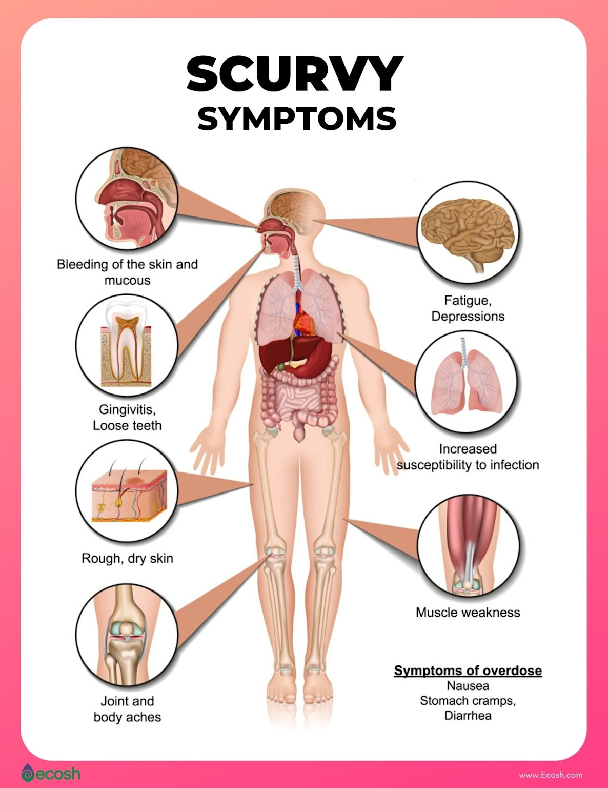 Symptoms of scurvy (Vitamin C deficiency) illustrated on the human body showing key signs like bleeding skin, gingivitis, fatigue, and muscle weakness