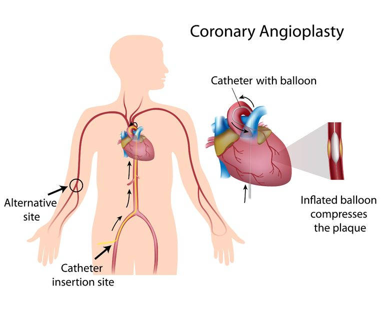 Illustration of coronary angioplasty showing catheter insertion, balloon inflation, and plaque compression in coronary arteries