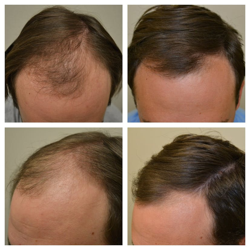 Before and after photos showing minoxidil's effectiveness in promoting hair regrowth and reducing baldness in men