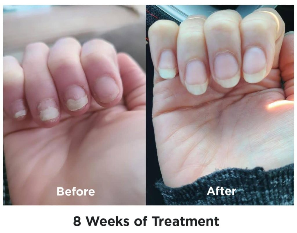 Before and after comparison showing significant improvement in brittle nails after 8 weeks of treatment