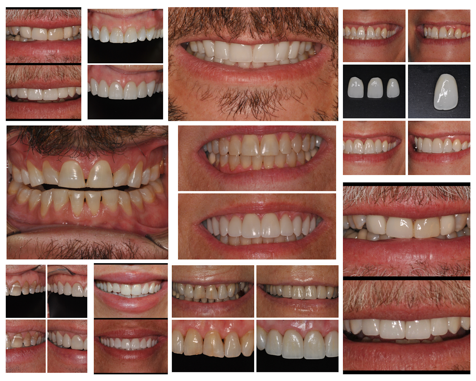 Orthodontics and braces in Lucknow