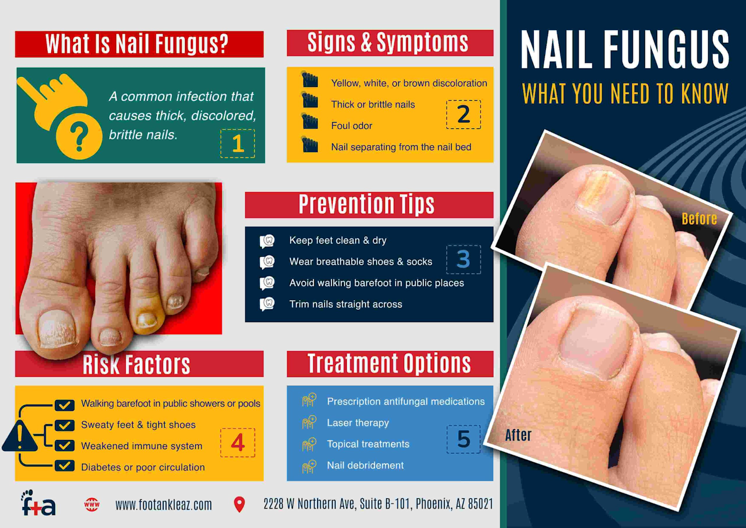 Infographic detailing nail fungus causes, symptoms, risk factors, prevention, and treatment options with before and after images