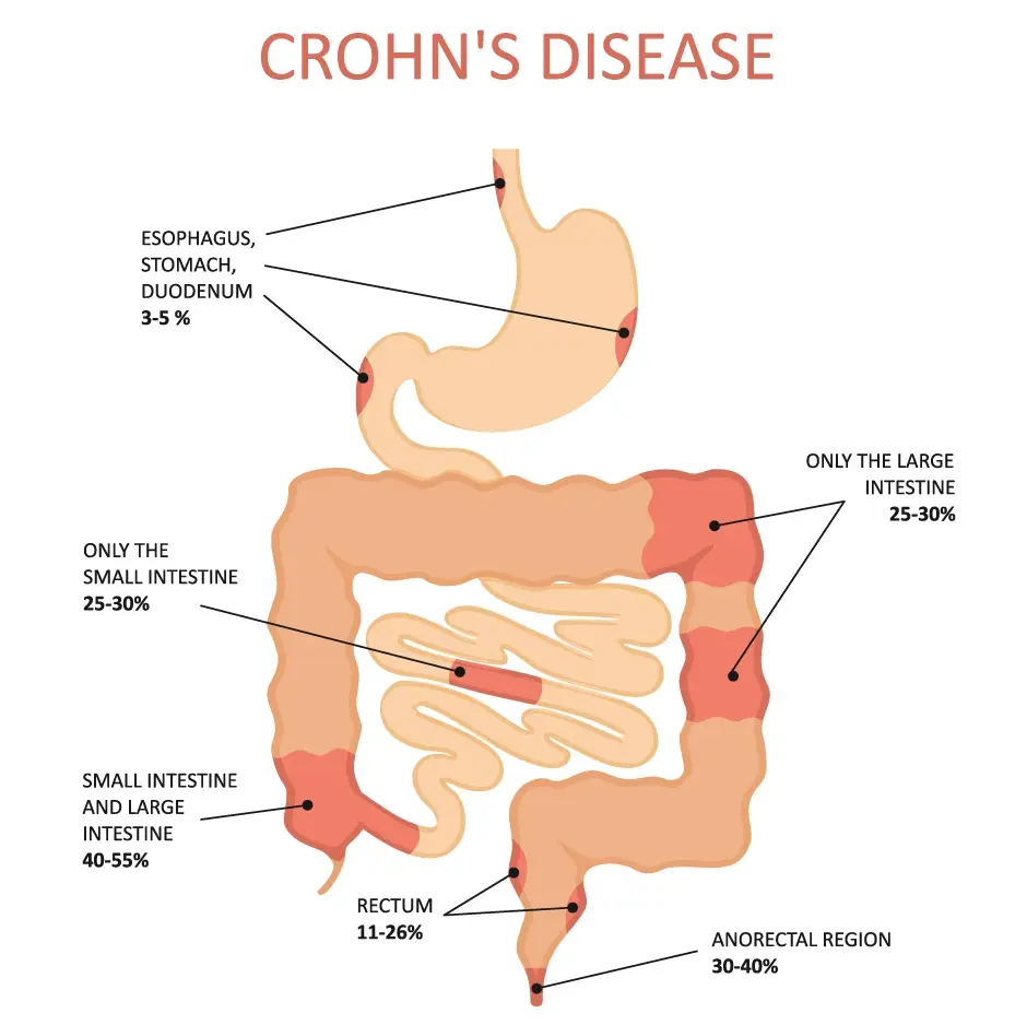 Diagram showing affected areas and prevalence percentages of Crohn's disease in the digestive tract