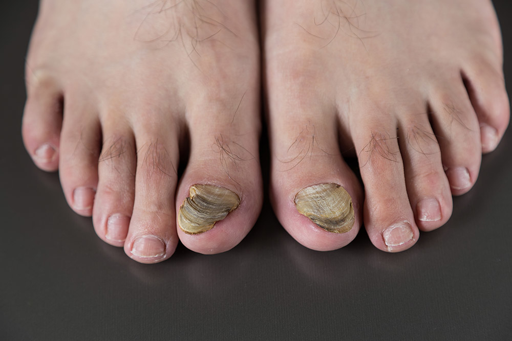 Toenails severely affected by fungal infection showing thickening and discoloration typical of onychomycosis