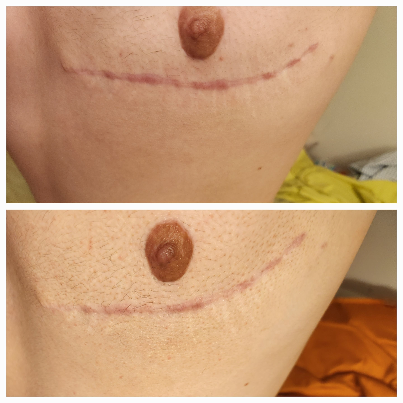 Comparison of a keloid scar before and after 1.5 months of silicone gel treatment showing reduced redness and raised texture.