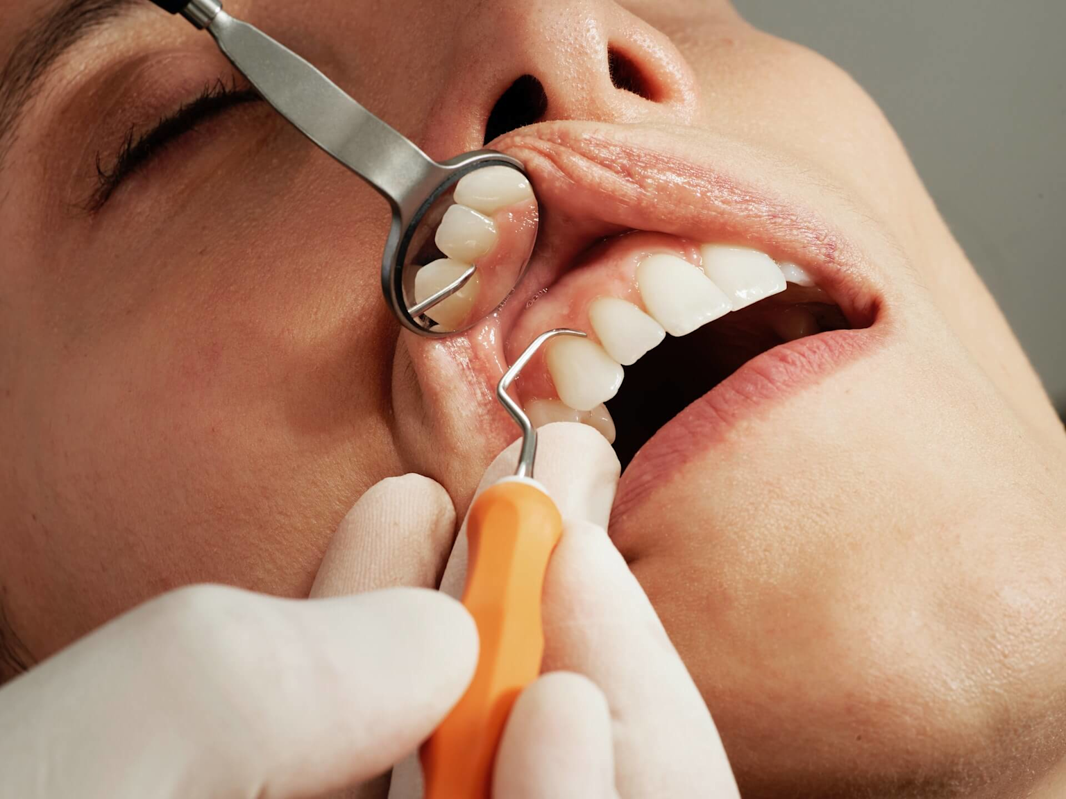 Professional teeth cleaning in Lucknow