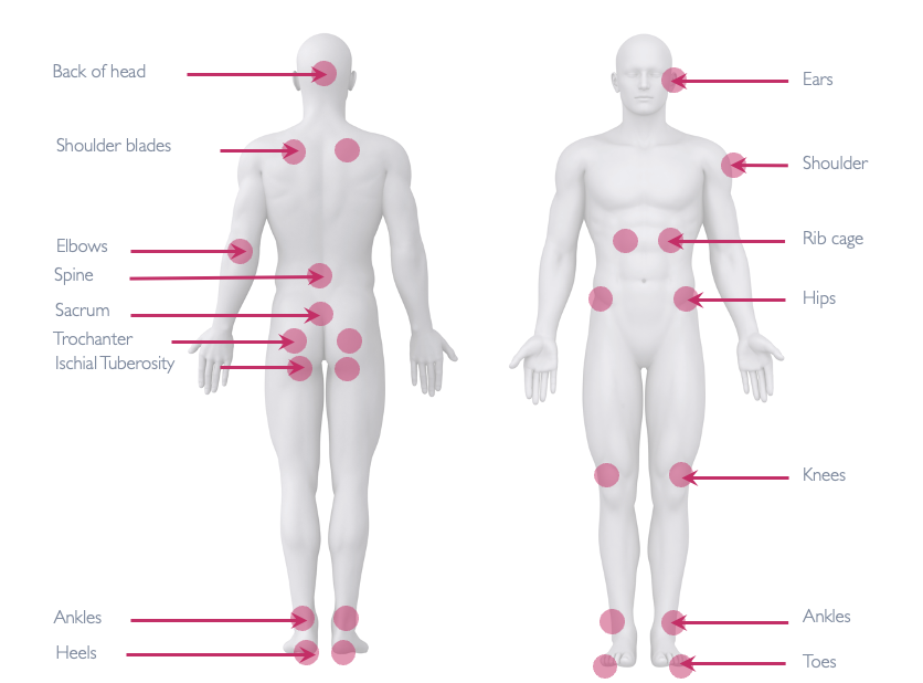 Anatomical diagram highlighting common pressure points vulnerable to pressure ulcers, essential for understanding pressure care in seating choices.