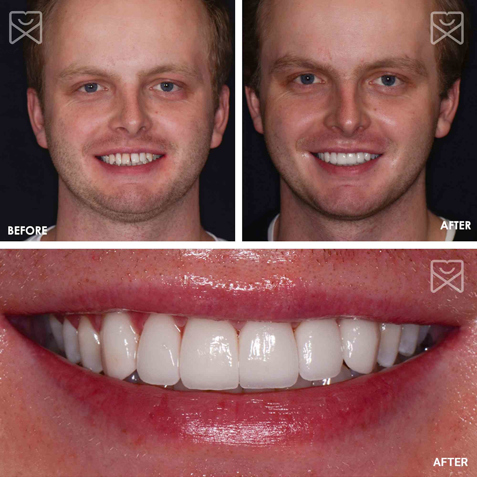 Dental implants and crowns in Lucknow