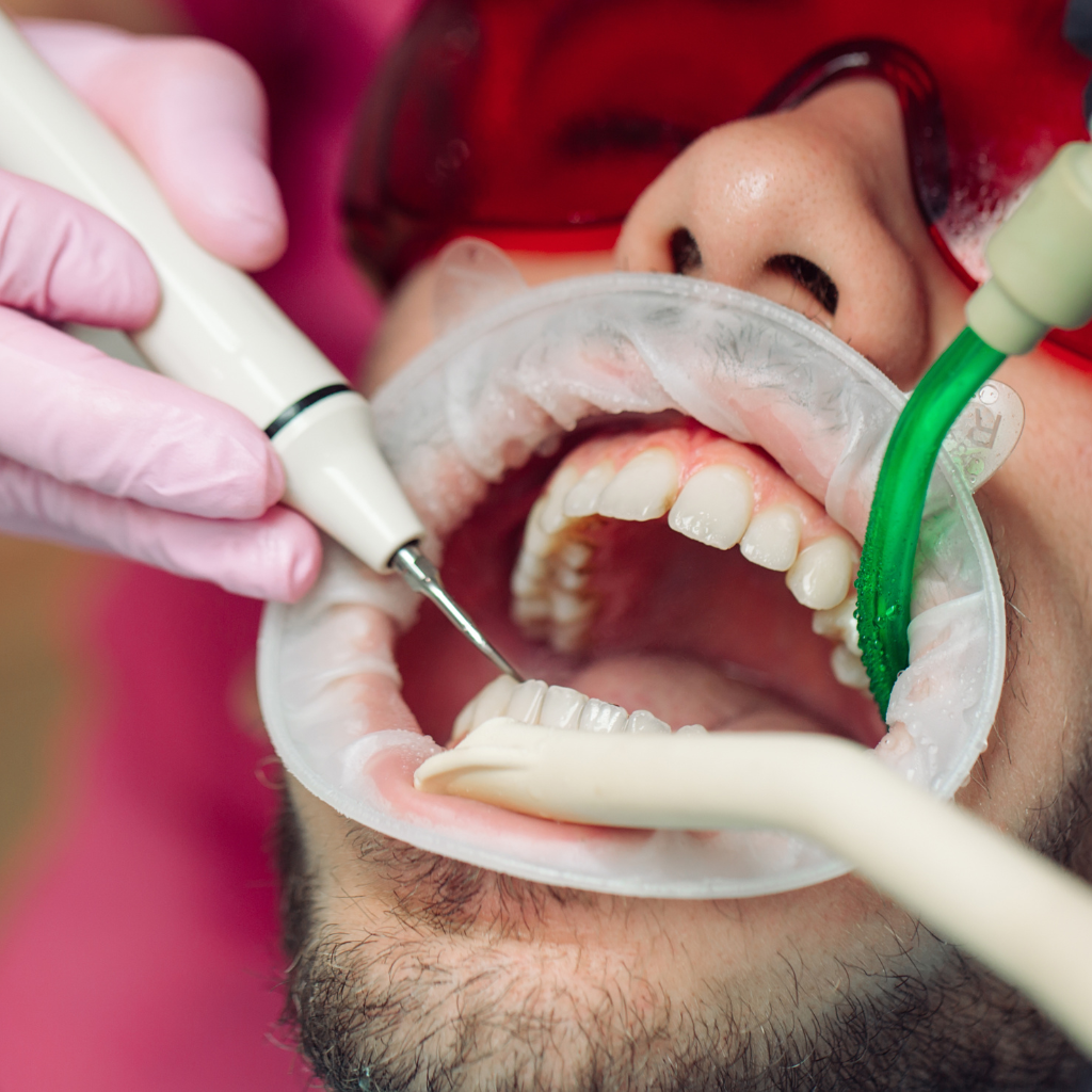 Root canal treatment in Lucknow