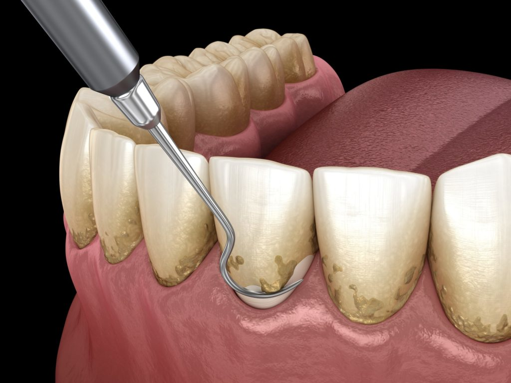 Gum disease treatment in Lucknow