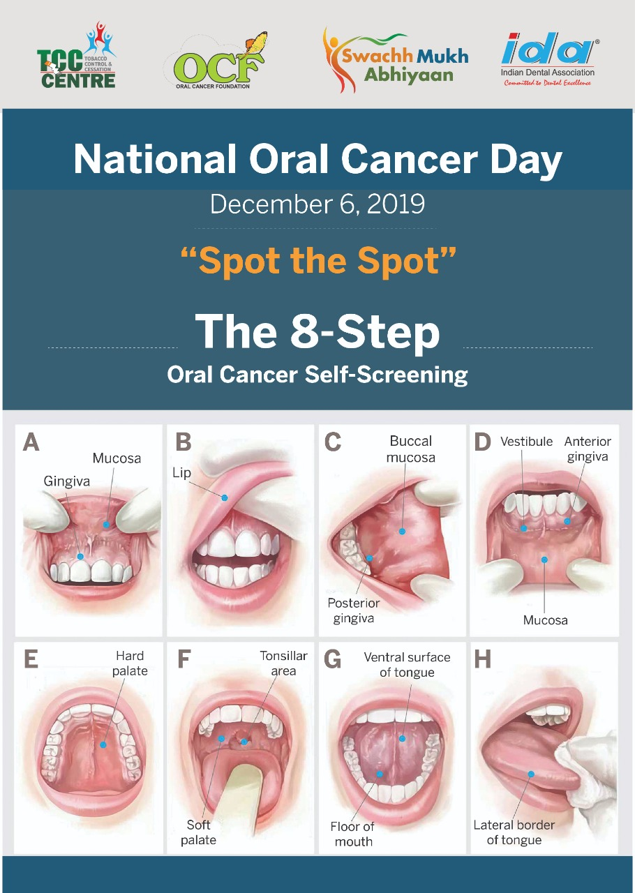 Oral cancer screening in Lucknow