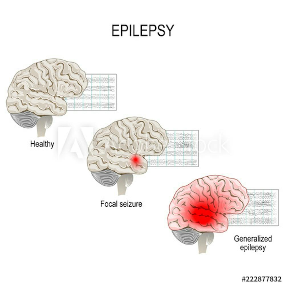 Diagrams showing healthy brain, focal seizure, and generalized epilepsy with corresponding EEG patterns.