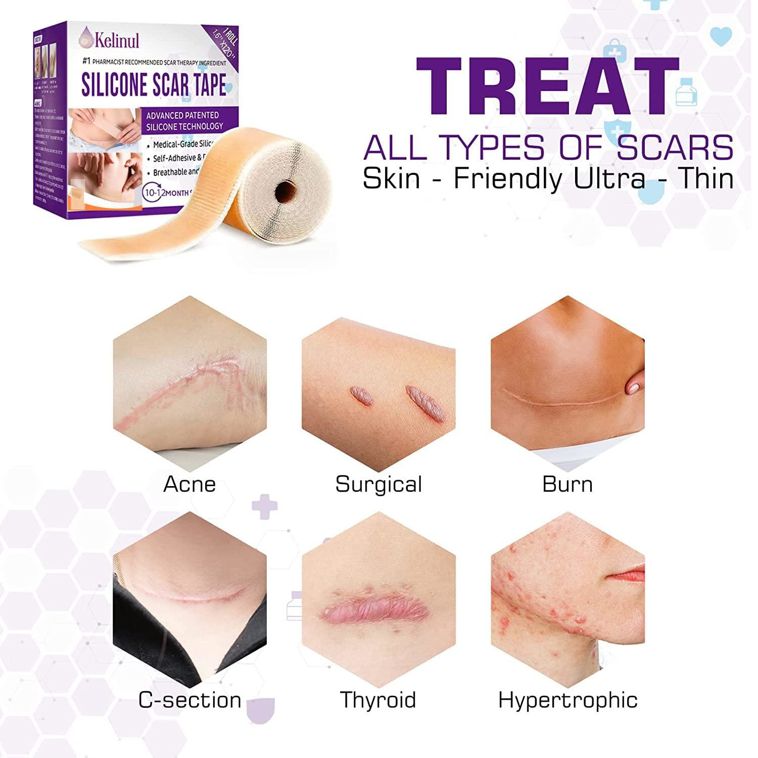 Kelinux silicone scar tape for treating various types of scars including acne, surgical, burn, C-section, thyroid, and hypertrophic scars.