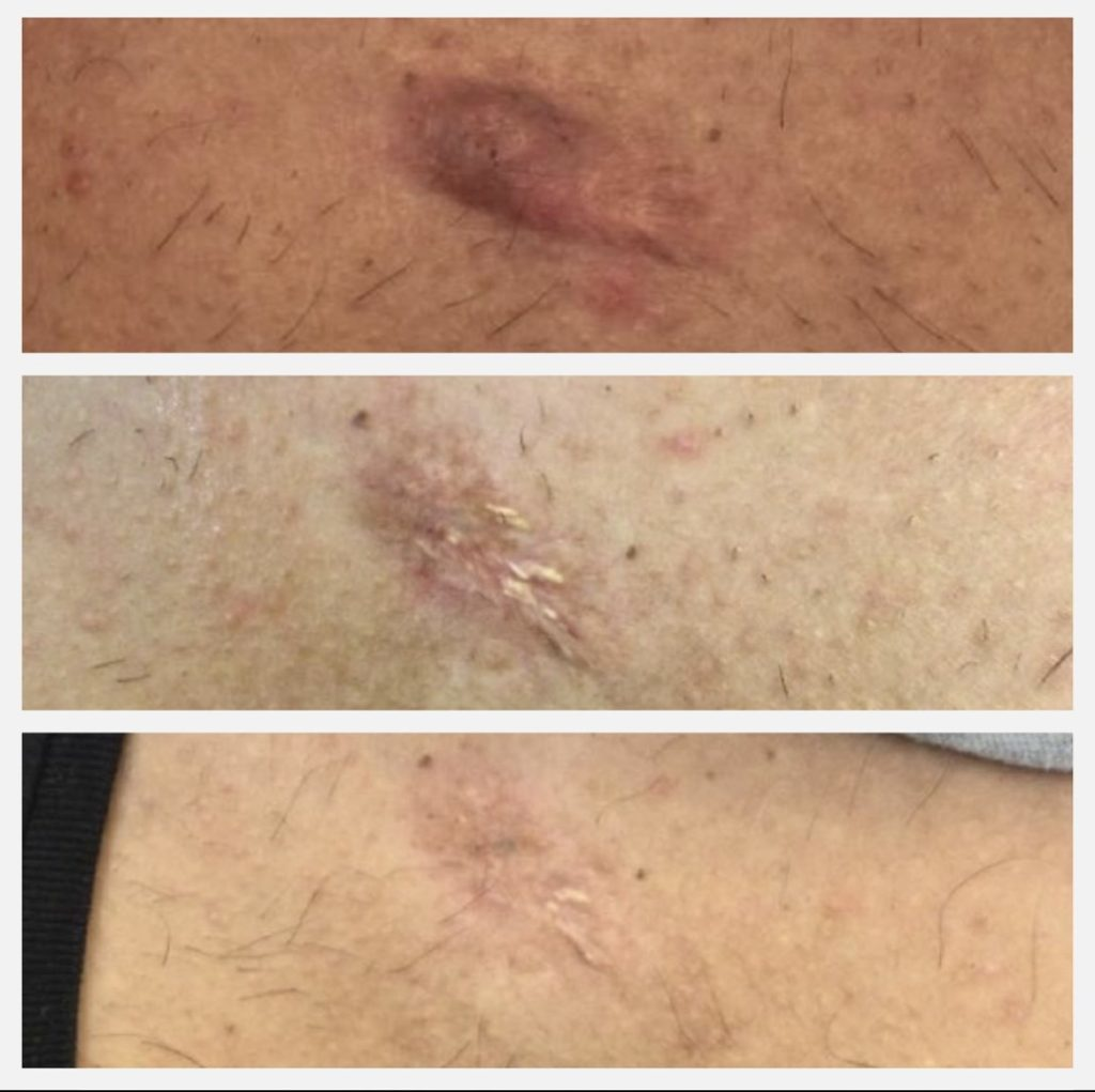 Progressive reduction of keloid scars on skin, showing before and after treatment results.